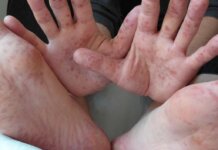 ¿Sabes qué es el virus de coxsackie del que se contagian los niños y niñas?